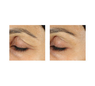 Image 2 du produit RoC - Retinol Correxion soin lissant crème pour les yeux, 15 ml