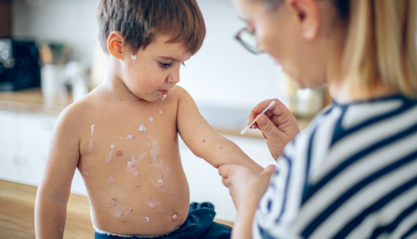 Varicelle et zona : quel est le lien entre les deux virus ?