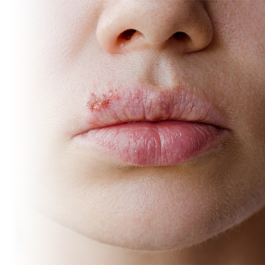 How can cold sores be prevented and cured? 