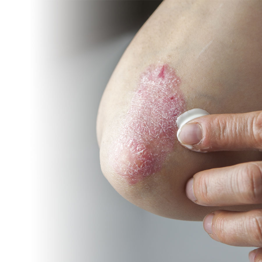 Tour d’horizon sur le psoriasis