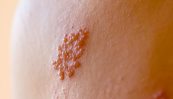 Le zona : quels sont les symptômes et comment le prévenir ?