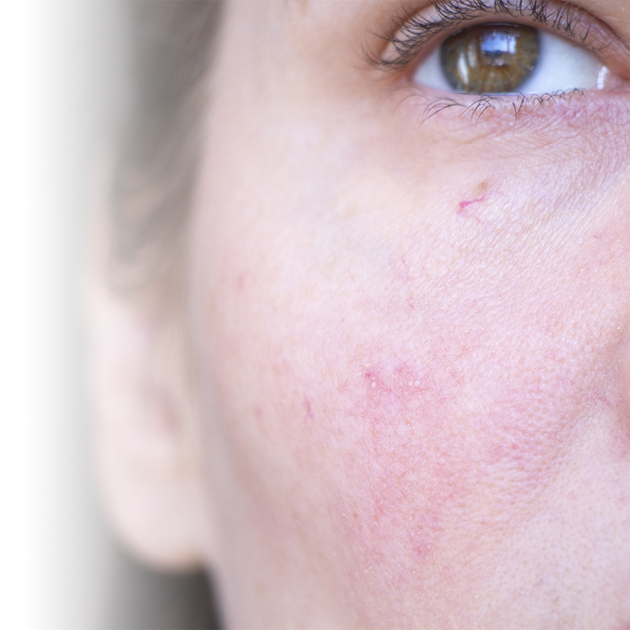 Combatting rosacea in cold weather