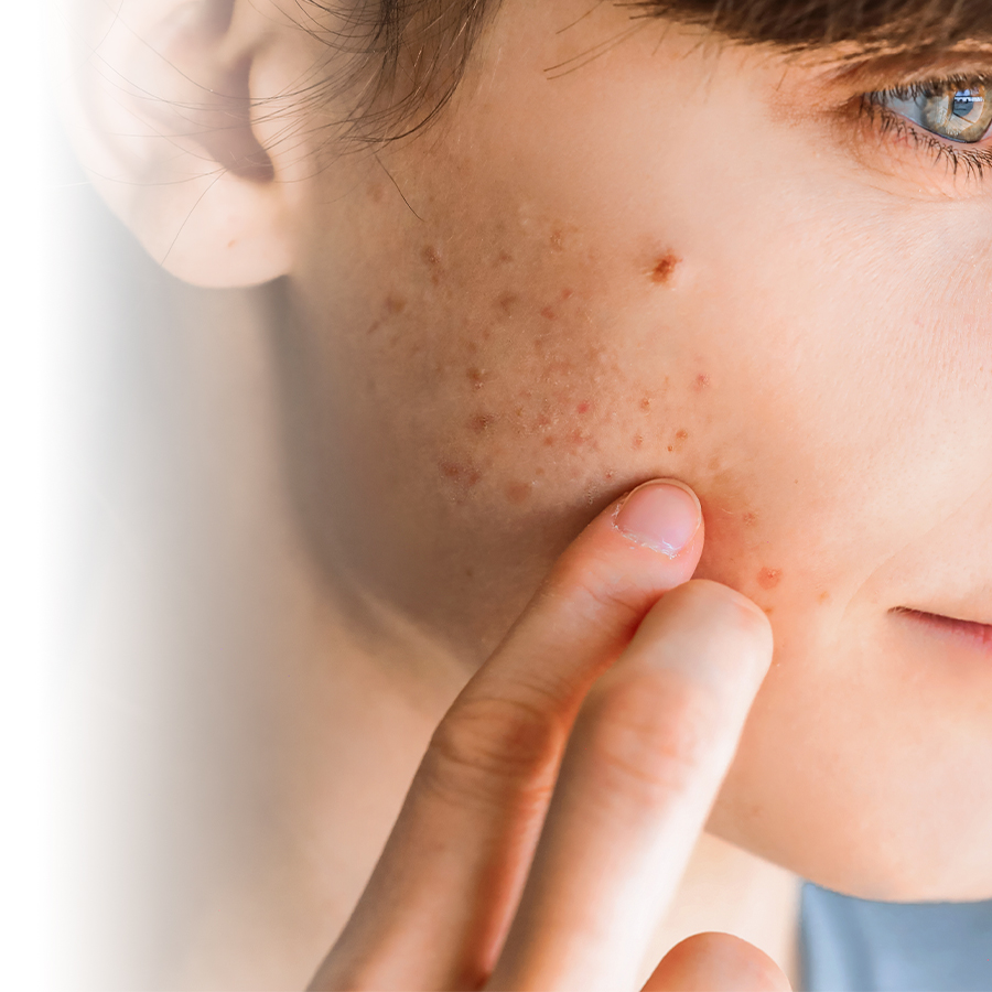 How to apply makeup to acne-prone skin