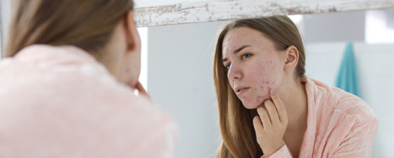 WHAT IS ACNE, EXACTLY?