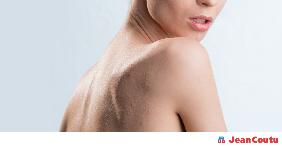 Comment éliminer l'acné du dos | Jean Coutu
