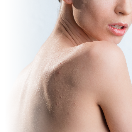 How to get rid of back acne