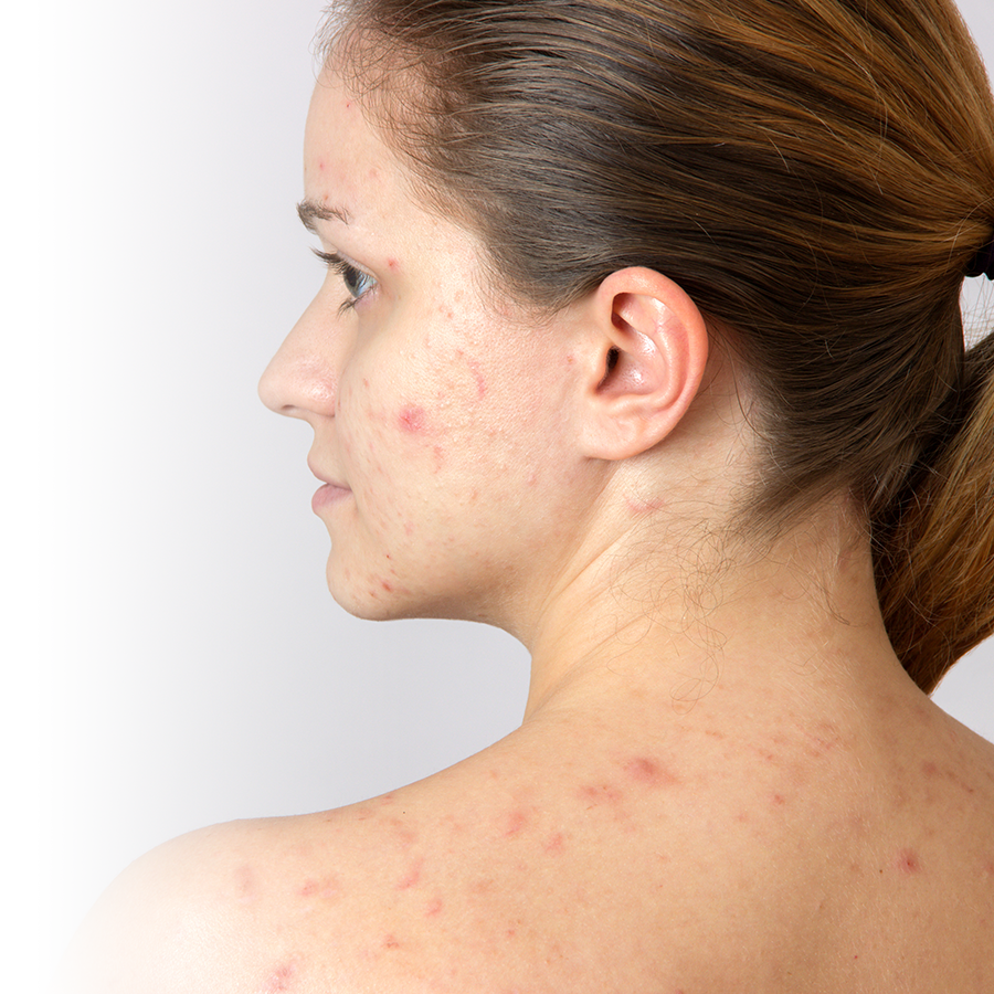 6 solutions to get rid of adult acne