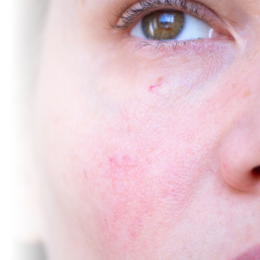Rosacea and couperose