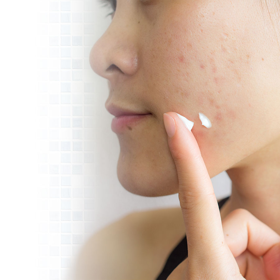 L'acné à l'âge adulte&nbsp;: mise au point et routine de soins