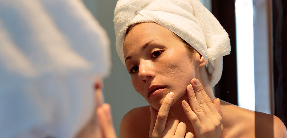 What is adult acne?