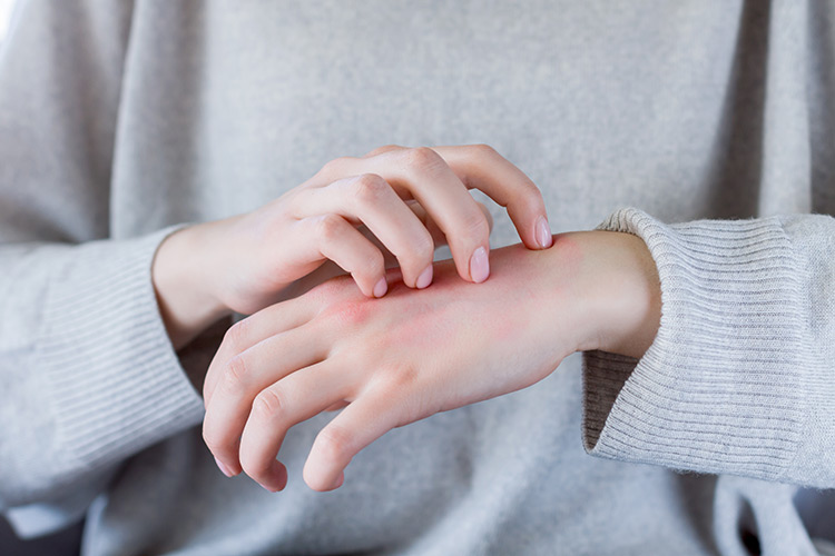 Comment se manifeste l’eczéma sur les paupières et les mains? 