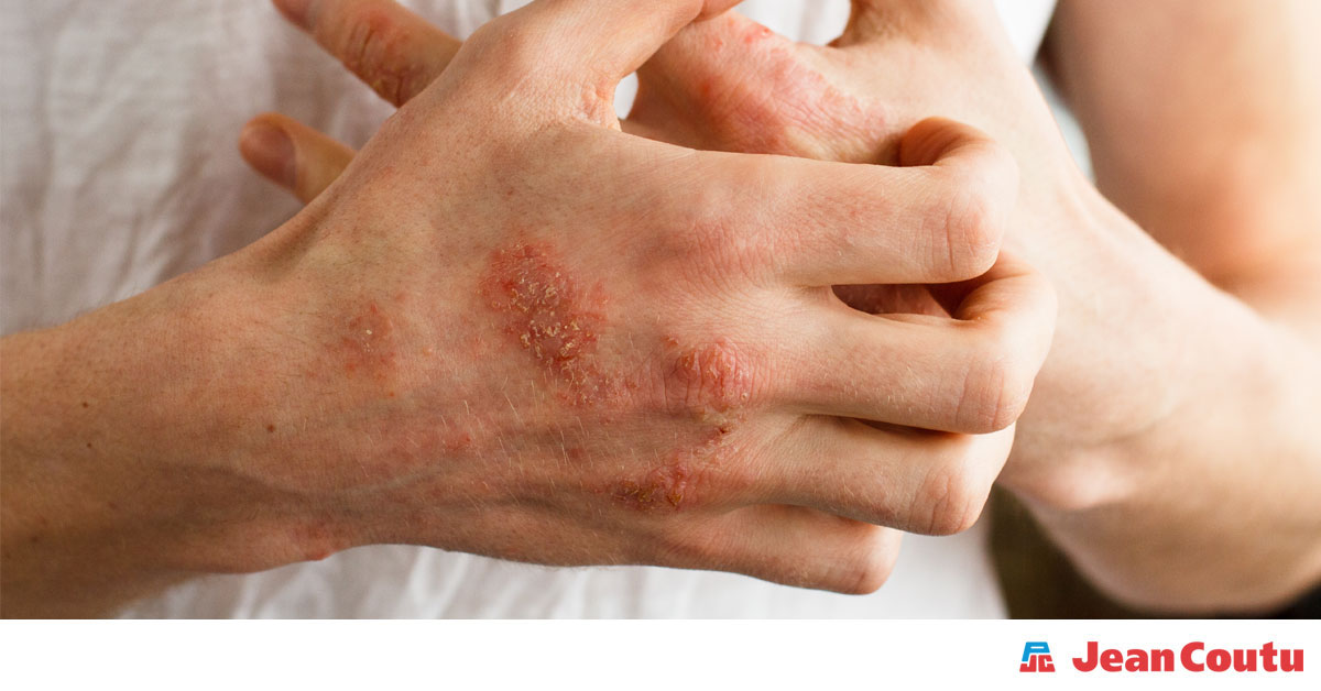 Eczema On Your Eyelids And Hands What S The Best Way To Care For It Jean Coutu