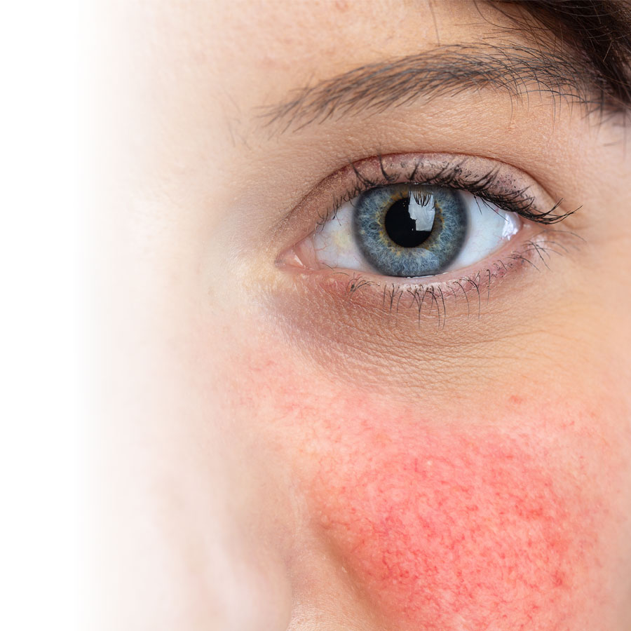 Rosacea: when skin is reactive and red