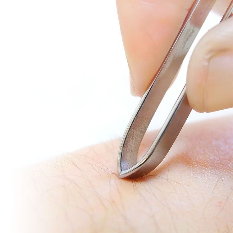 How to recognize, prevent and treat ingrown hairs