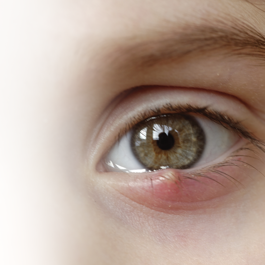 What is a stye and how is it treated?