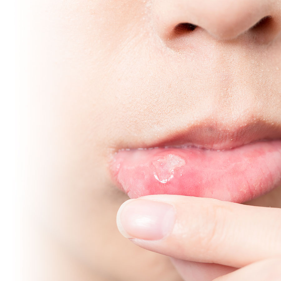 How can mouth ulcers be treated?