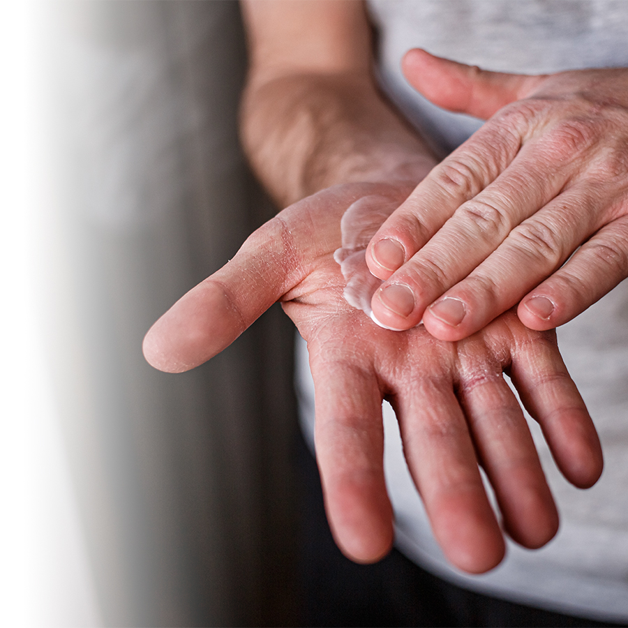 Les gerçures : quand les mains ont la vie dure