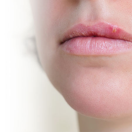 Fifteen tips to avoid cold sores