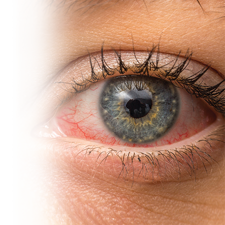 How to recognize and treat conjunctivitis