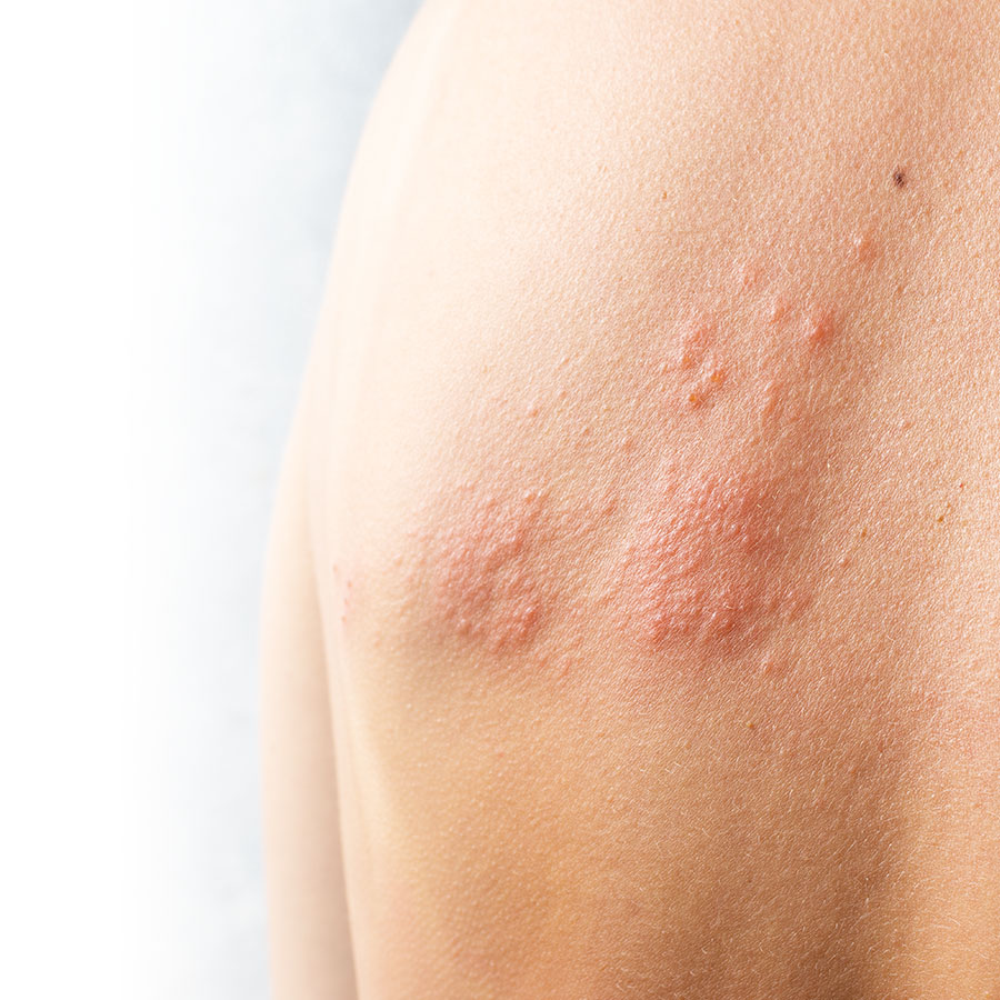 Understanding shingles to better protect yourself