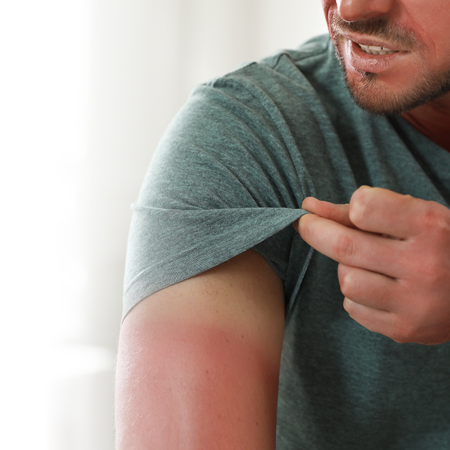 Photosensibilisation&nbsp;: quels sont les risques pour votre santé?