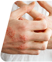 Eczéma sur les paupières et les mains : quels soins adopter?