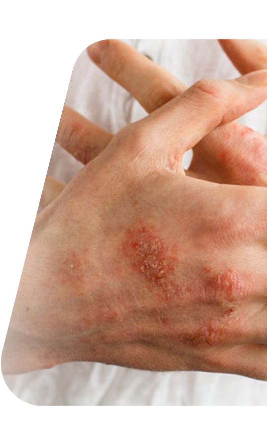 Eczema on your eyelids and hands: what’s the best way to care for it?